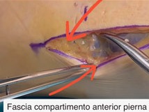 Fascia del compartimento anterior de la pierna y nervio peroneo superficial señalados durante la intervención