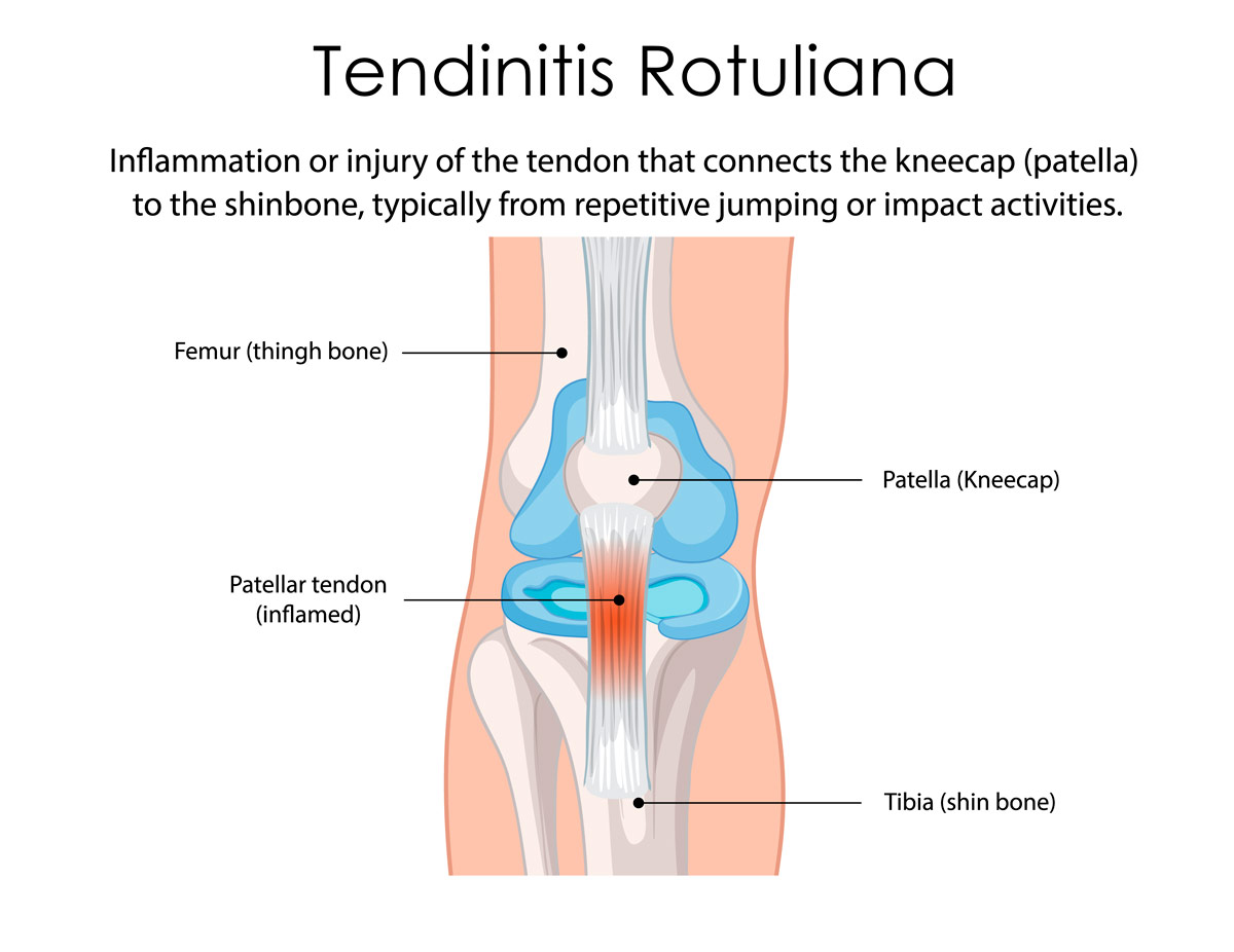 Tendinitis rotuliana, lesiones en runners