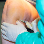 Infiltración articular, factores de crecimiento