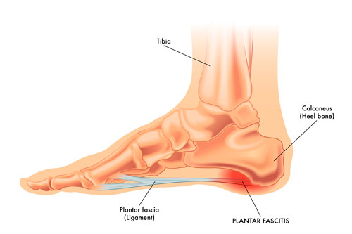 Dolor de Fascitis plantar, fascia planta del pie