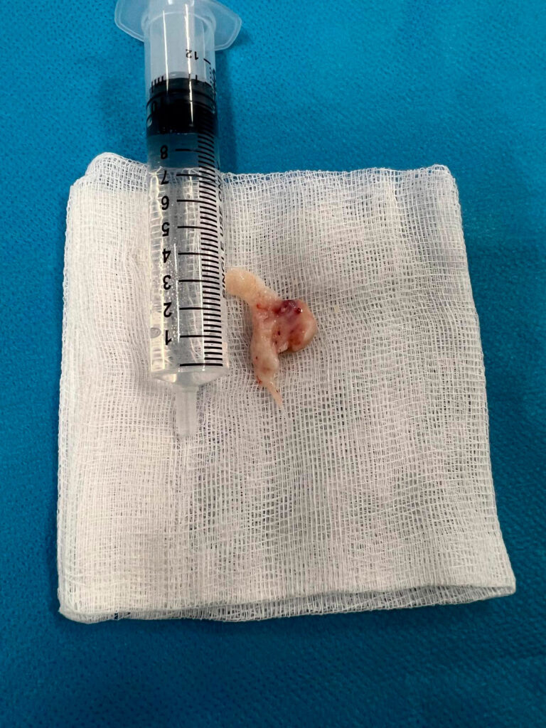 Restos ligamentosos que propician el bloqueo de rodilla