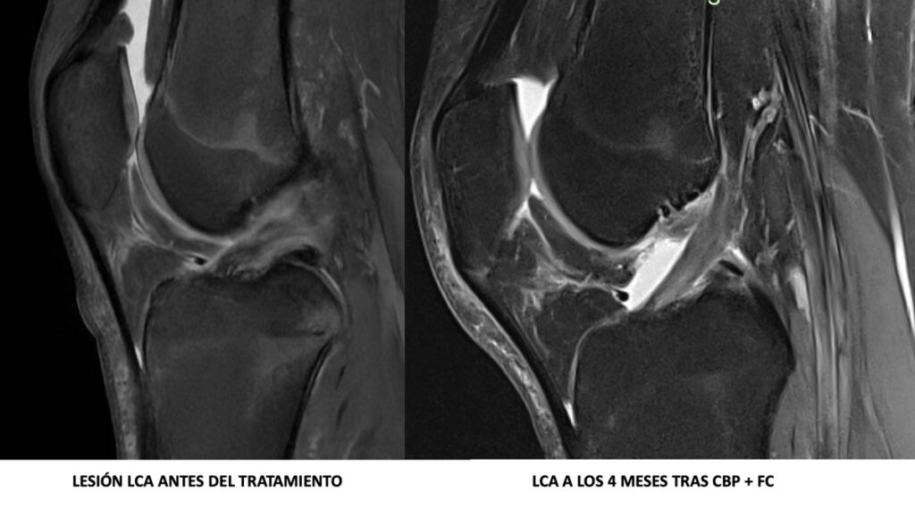 Antes y después del protocolo Cross Bracing