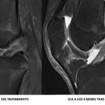 Antes y después del protocolo Cross Bracing