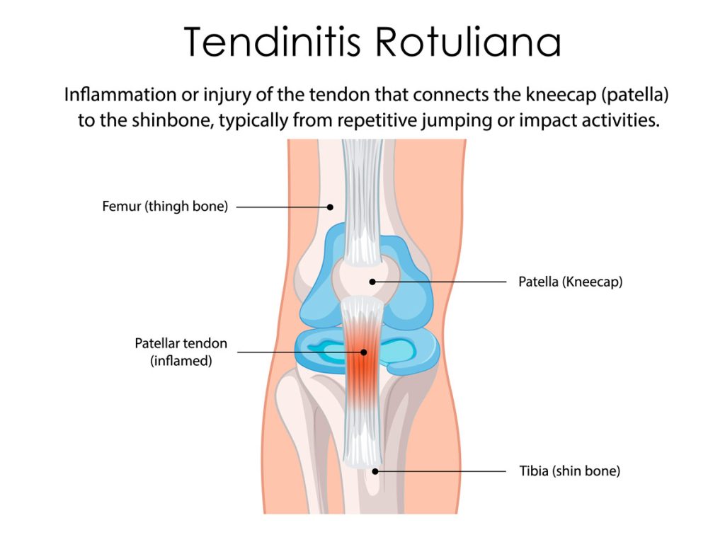 Tendinitis rotuliana, lesiones en runners
