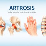 Artrosis, tratamiento